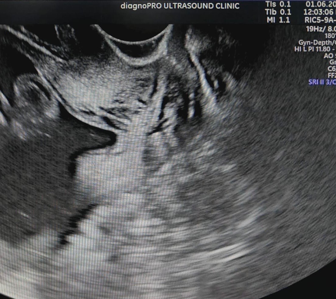 TVS ultrasound revealing short cervical length with cervical funneling