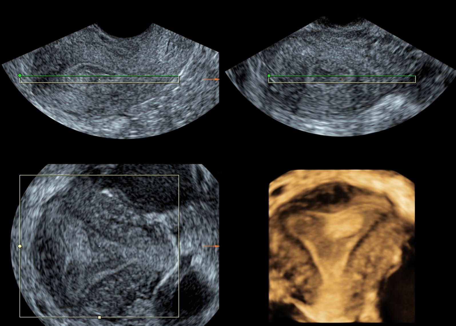 3D/4D TVS(TRANSVAGINAL SCAN)