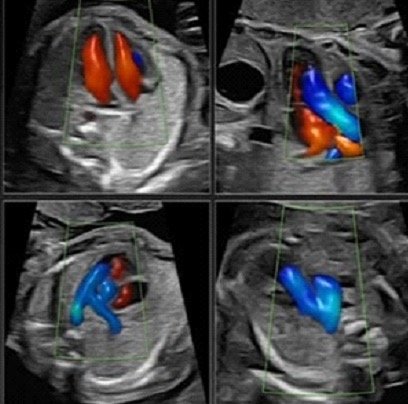 Fetal Echo