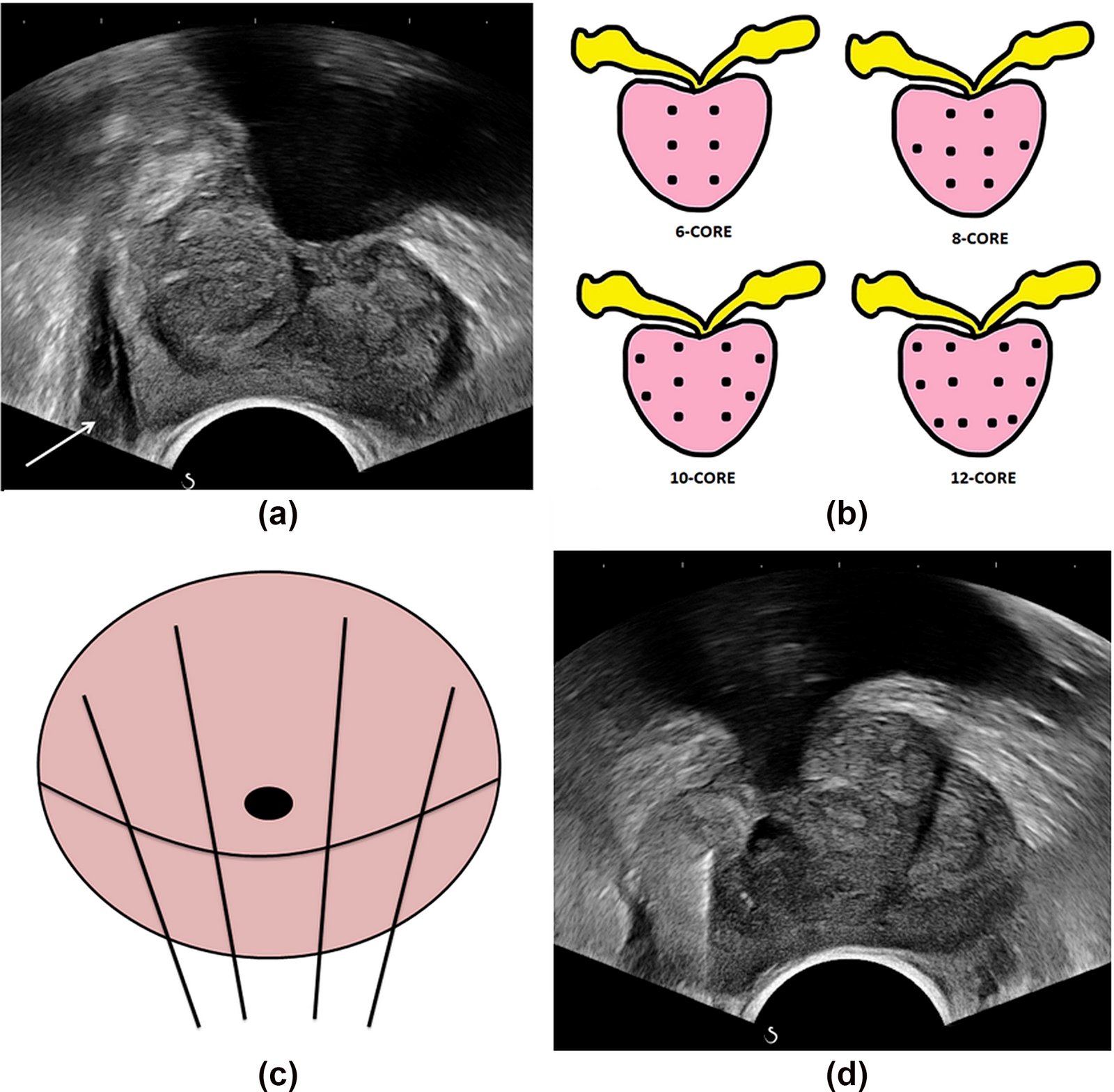 TRUS(TRANSRECTAL ULTRASOUND)