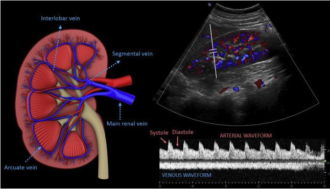 RENAL DOPPLER
